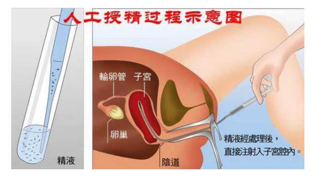 广州50岁卵试管受孕的概率_广州41岁供卵怀孕有风险吗_人工授精助孕预产期是怎